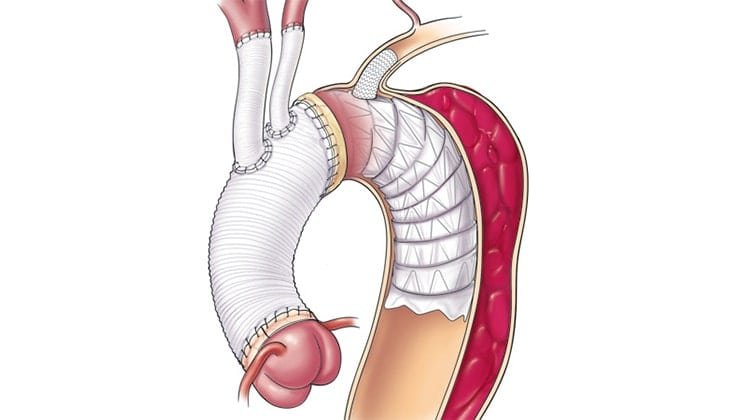 Aortic Dissection Repair