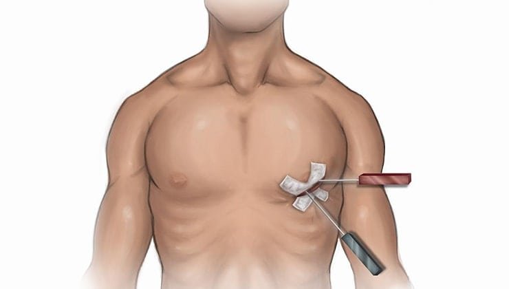 Keyhole Cardiac Surgery