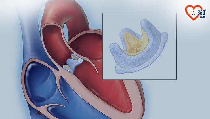 Aortic Valve Replacement Surgery Cost In India