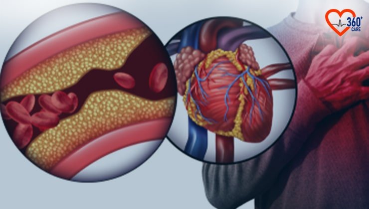 Heart blockage surgery cost in india