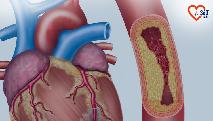 how to check heart blockage at home